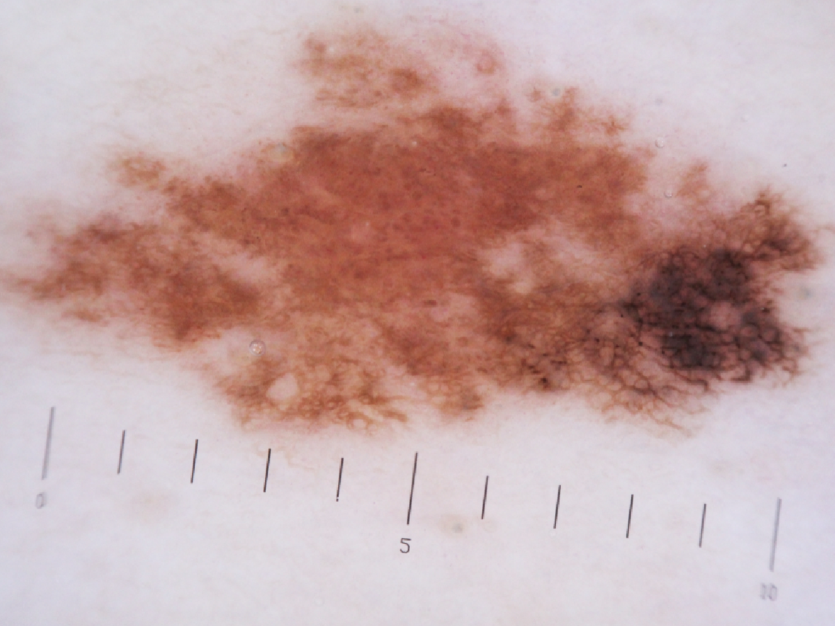 melanoma